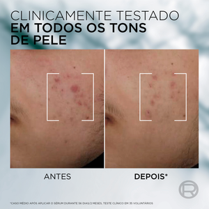 L'Oréal Paris Men Expert Sérum Derma Control 30 ml